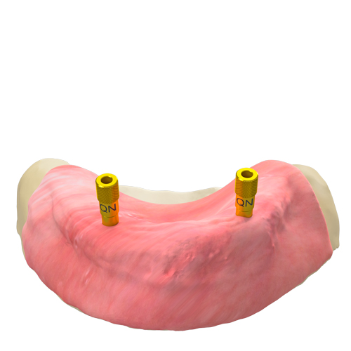 Geführter Schablonen-Fixationspin – vertikal, QN/H8/d3.5 (GS)
