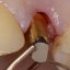 SilverPlug – antibakterielles Verschlussmaterial für den Implantatschraubenkanal