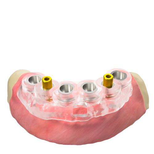Geführter Schablonen-Fixationspin – vertikal, QN/H8/d3.5 (GS)