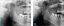 1. Situation before sinus grafting. 2. Bone graft PORESORB-TCP was mixed with autologous bone. Situation six months after sinus lift and before implant insertion. (Dr. M. D. Cevallos Lecaro, Ph.D.)