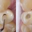 SilverPlug – antibakterielles Verschlussmaterial für den Implantatschraubenkanal