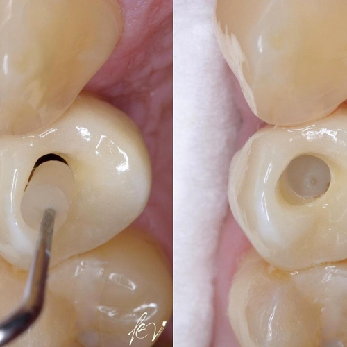 SilverPlug – antibakterielles Verschlussmaterial für den Implantatschraubenkanal