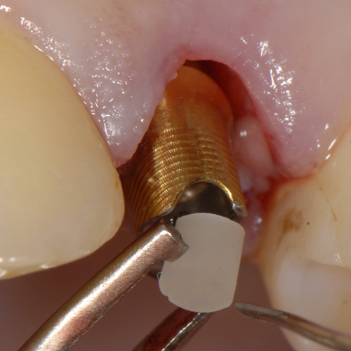 SilverPlug – antibakterielles Verschlussmaterial für den Implantatschraubenkanal