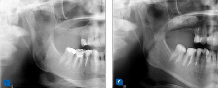 1. Situation before sinus grafting. 2. Bone graft PORESORB-TCP was mixed with autologous bone. Situation six months after sinus lift and before implant insertion. (Dr. M. D. Cevallos Lecaro, Ph.D.)