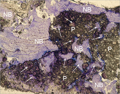 Seven months after sinus lift: The new formed bone is in direct contact with PORESORB-TCP bone graft. The arrows show the newly formed bone in bone grafts pores. (Dr. M. D. Cevallos Lecaro, Ph.D.)